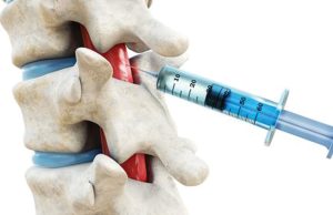 Injections – Minnesota Institute For Pain Management