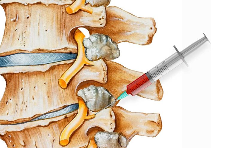 Medial Branch Blocks – Minnesota Institute For Pain Management